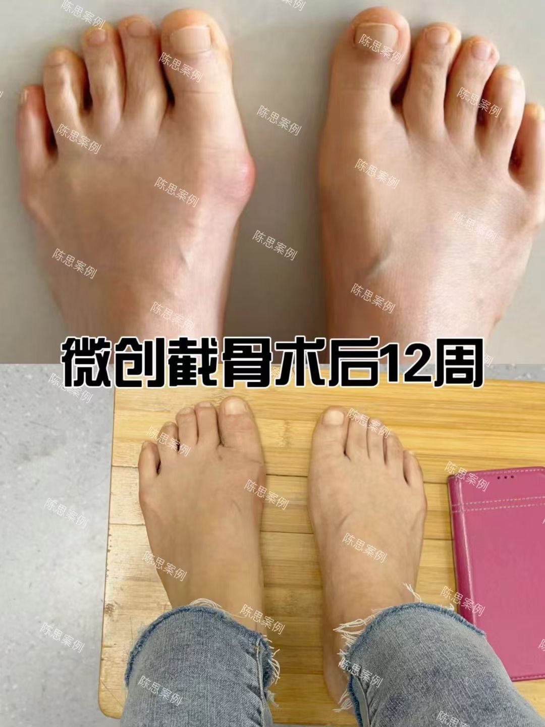 JJJ正式接受脚趾手术三个月后重新评估
