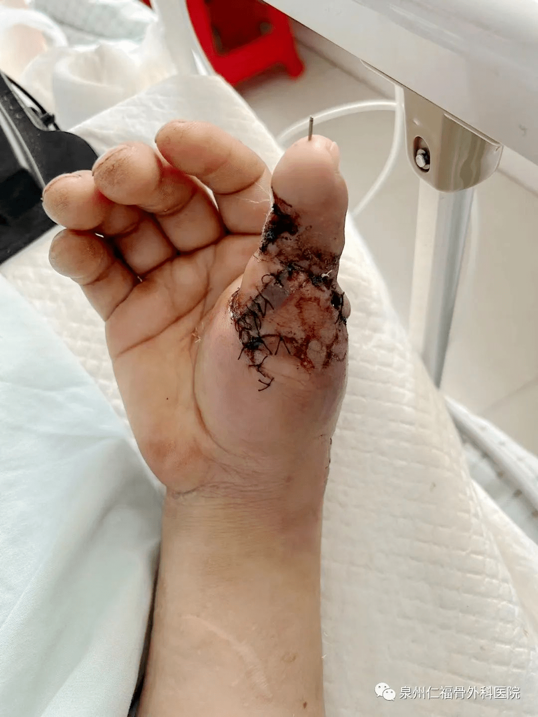 JJJ正式接受脚趾手术三个月后重新评估